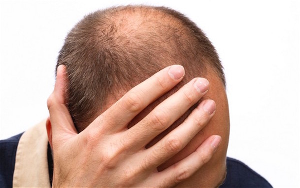 درمان ریزش موی آقایان