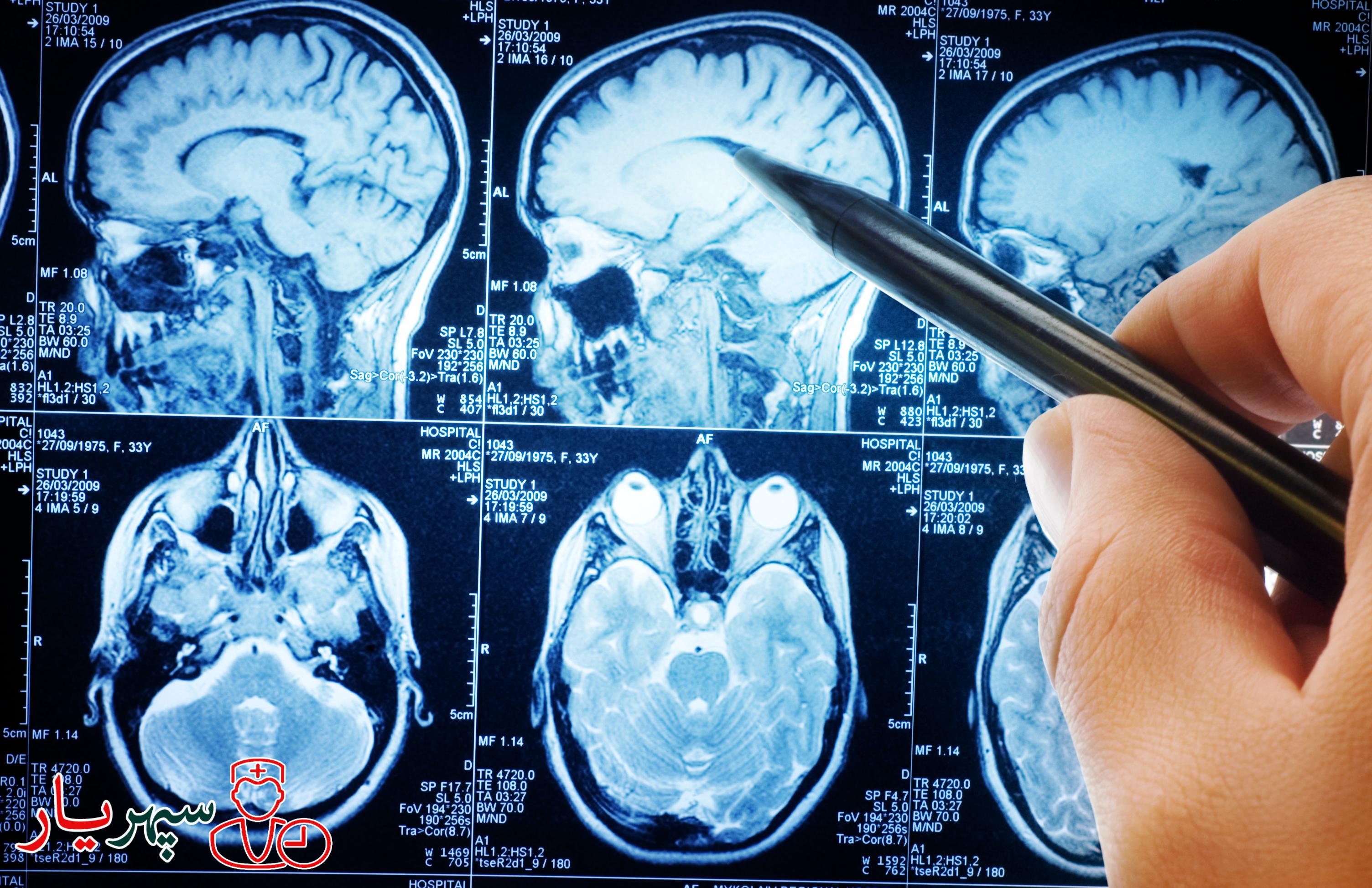 ضربه مغزی چیست و چه علائمی دارد؟