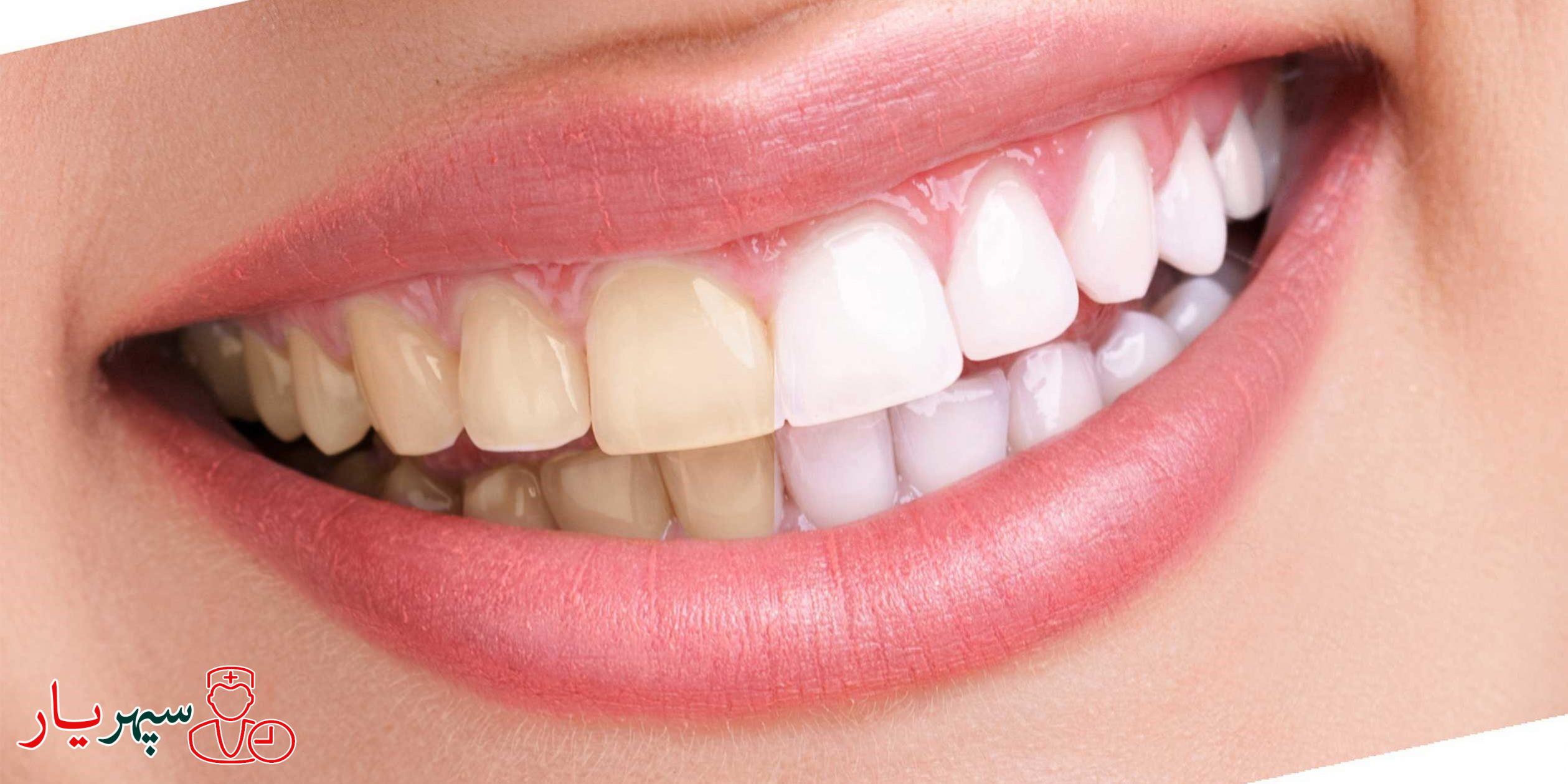 روش های طبیعی سفید کردن دندان
